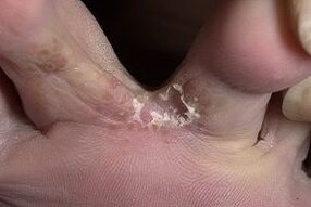 grybelio simptomai ant kojų
