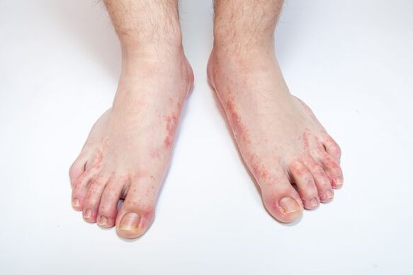 odos grybelis ant kojų