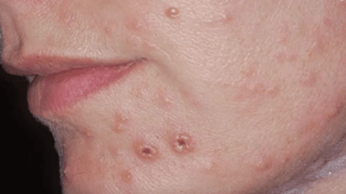 Grybelinė veido odos infekcija