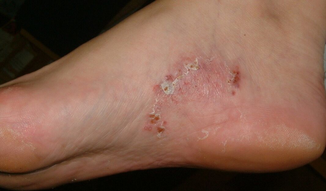 Grybelinės infekcijos apraiškos ant pėdos
