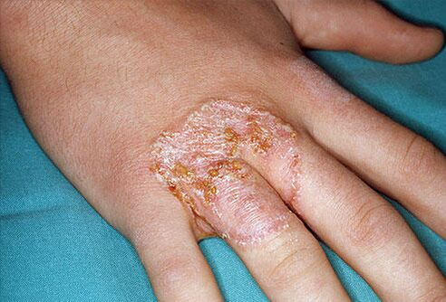 Kaklo formos raudonos dėmės ant rankų odos dėl mikozės