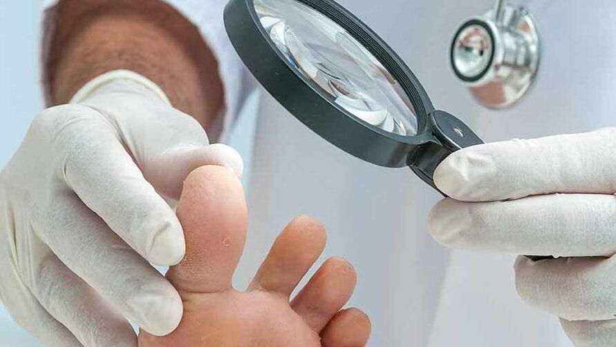 Kojų nagų grybelio diagnozę atlieka dermatologas